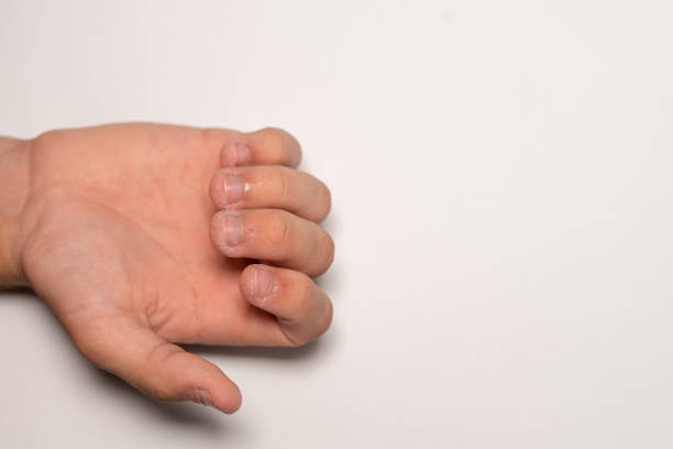 Unattractive bitten fingernails on a man's hand