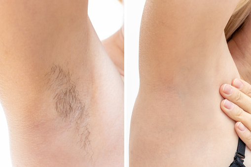 Axilas de mujer, axila antes y después de la depilación, depilación con láser y azúcar photo