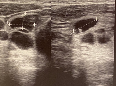 Ultrasound image of cyst in human thyroid gland