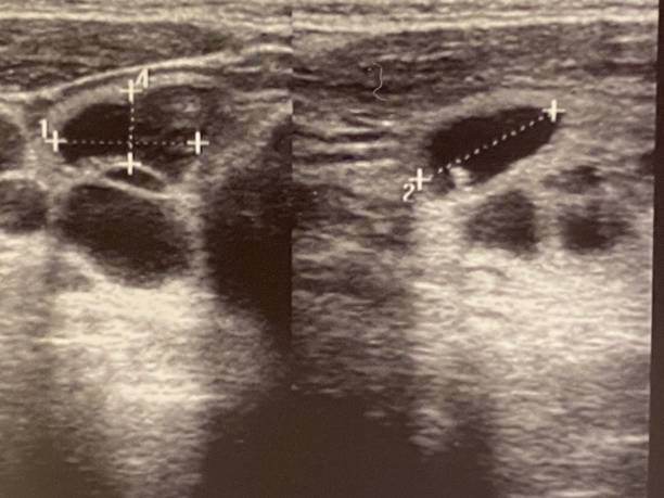 ультразвуковое изображение кисты в щитовидной железе человека - ultrasound cancer healthcare and medicine thyroid gland стоковые фото и изображения