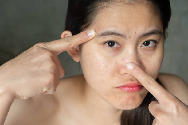 istock Portrait of Asian woman pointing acne problem on her face. 1189667493