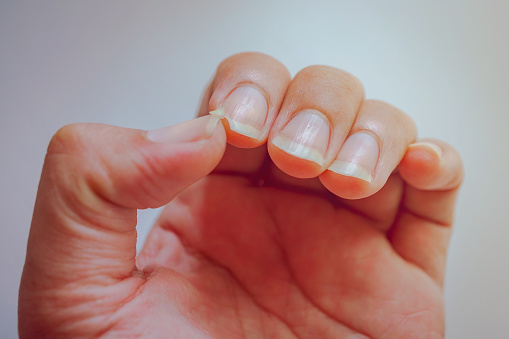 La uña en el desgarro del dedo índice. Causar dolor en las yemas de los dedos. photo