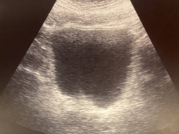 ultrasonde de la vessie humaine et de la glande prostaste - prostate gland photos et images de collection