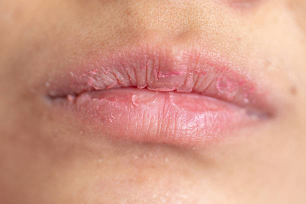 Backgrounds of Dry lips in the clinic. stock photo