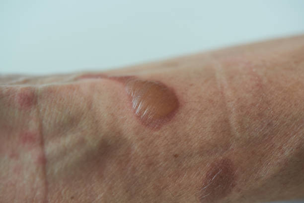 istock Close-up view of second degree burn at left forearm 1189924026