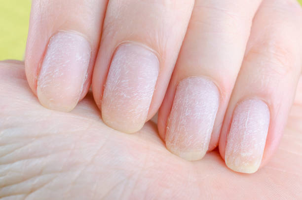 istock damaged nails after removing modern gel nail polish 1189936748