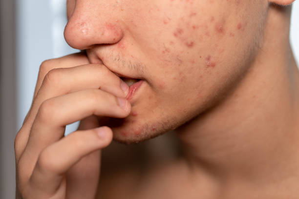 un joven con acné y granos en la cara, mordiéndose las uñas. - dot gain fotos fotografías e imágenes de stock