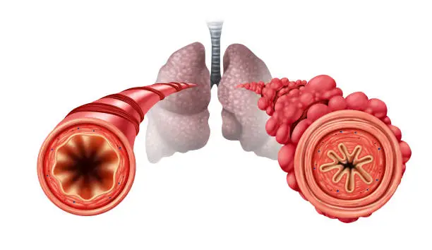 Popcorn lung condition concept or obliterative bronchiolitis disease as obstructed bronchial tubes constricted caused by vaping respiratory muscle tightening and swelling with 3D illustration elements.