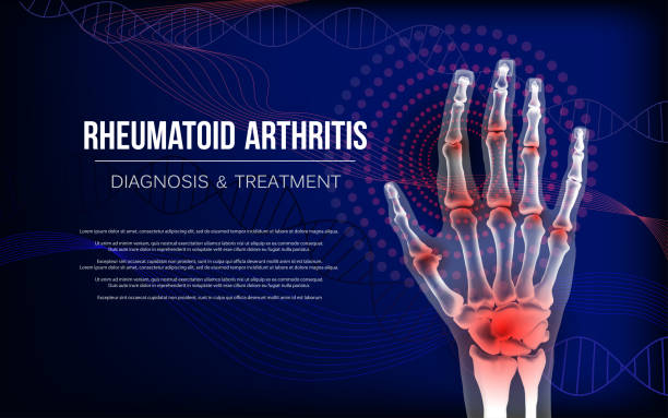 rheumatoide arthritis arthrose banner entzündung gelenke der knochen der hand. - rheumatism human finger human hand human arm stock-grafiken, -clipart, -cartoons und -symbole