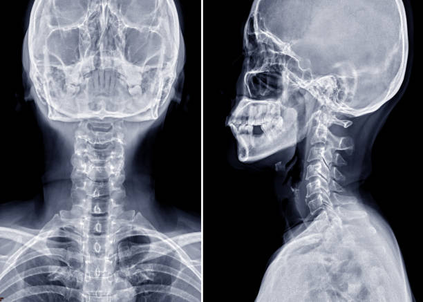 istock X-ray C-spine or x-ray image of Cervical spine AP and Lateral view for diagnostic intervertebral disc herniation. 1190189524