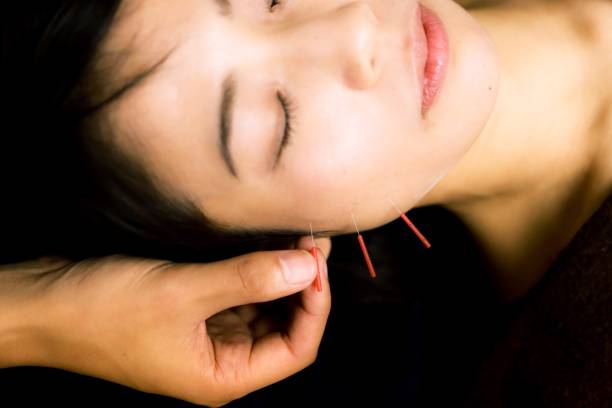 agopuntura cosmetica in asia - acupuncture spa treatment asian culture medicine foto e immagini stock