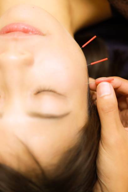 istock Cosmetic acupuncture in Asia 1190392314