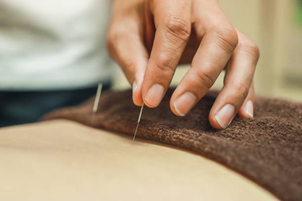 Alternative Medicine which is acupuncture in Asia Acupuncture needles for woman's body acupuncture photos stock pictures, royalty-free photos & images