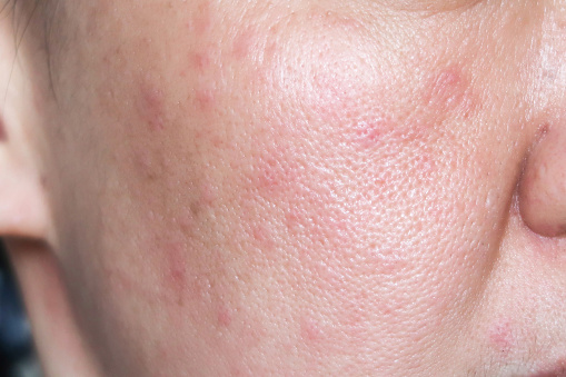 close-up profile of a young Caucasian woman suffering from the skin chronic disease rosacea on her face in the acute stage. Dermatological problems.  isolated on a beige background