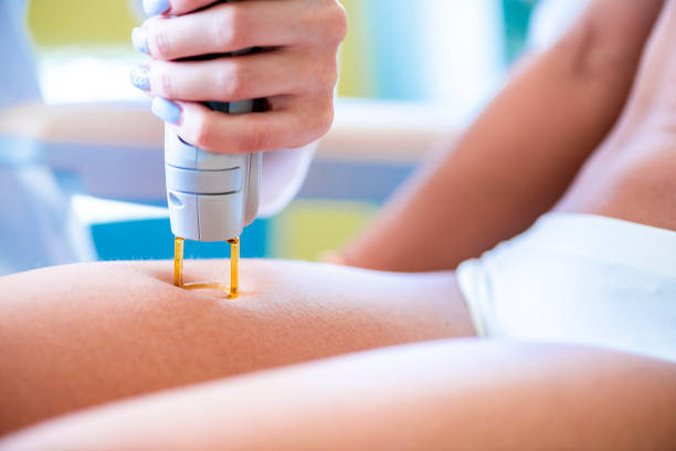 istock A cosmetician performing a laser depilation on a thigh area 1190579887