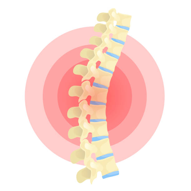 ilustraciones, imágenes clip art, dibujos animados e iconos de stock de ilustración aislada de color vectorial plano de deformación de la columna vertebral - deformed