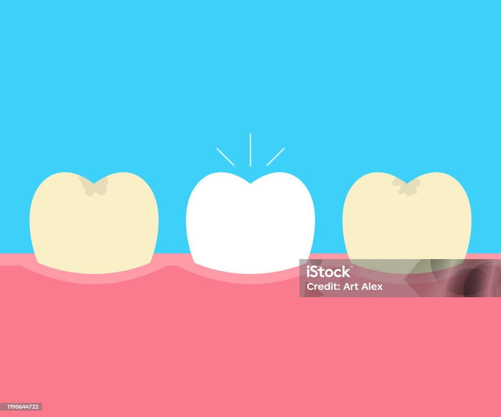 Clearing Tooth Before And After Whitening Oral Care Concept Deep Cleaning Clearing ...