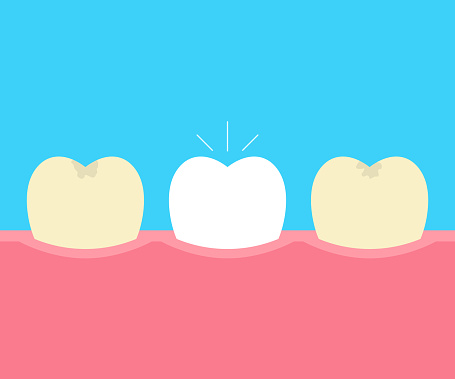 Clearing Tooth Before And After Whitening Oral Care Concept Deep Cleaning Clearing ...