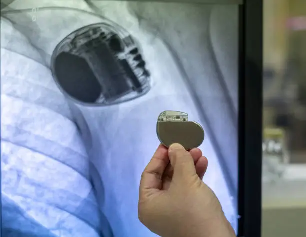 Photo of Doctor Hand hold Pacemaker device with screen of x-ray image permanent pacemaker implantation