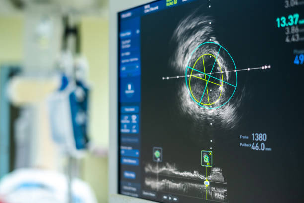 Intravascular ultrasound imaging (IVUS) at cardiac catheterization laboratory room. stock photo