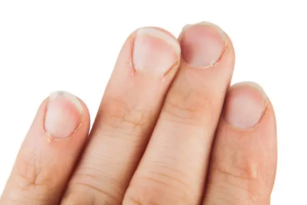 Damaged nails of an adult male isolated on a white background