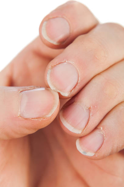 uñas dañadas de un macho adulto aislado sobre un fondo blanco - nail biting biting fingernail obsessive fotografías e imágenes de stock