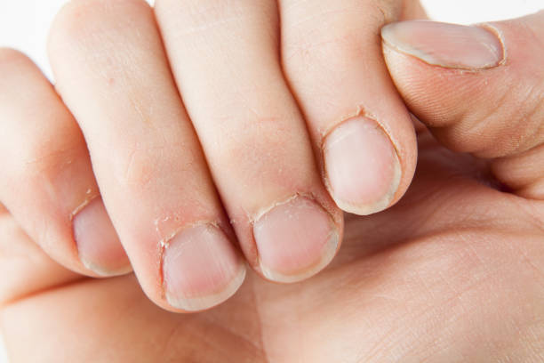 unghie danneggiate di un maschio adulto isolato su uno sfondo bianco - nail biting biting fingernail obsessive foto e immagini stock