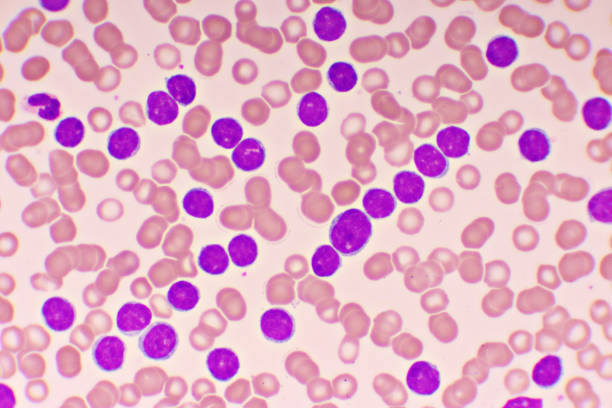istock Blood picture of chronic lymphocytic leukemia or CLL 1190863700
