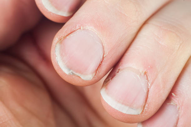 unghie danneggiate di un maschio adulto isolato su uno sfondo bianco - nail biting biting fingernail obsessive foto e immagini stock