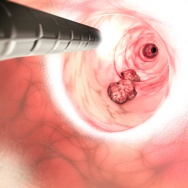 Internal view of the intestinal walls. Colorectal cancer (CRC), bowel cancer, colon cancer, or rectal cancer. Abnormal growth of cells that invade or spread to other parts of the body. 3d render Internal view of the intestinal walls. Colorectal cancer (CRC), bowel cancer, colon cancer, or rectal cancer, is the development of cancer from the colon or rectum (parts of the large intestine). A cancer is the abnormal growth of cells that have the ability to invade or spread to other parts of the body. 3d render colonoscopy stock pictures, royalty-free photos & images