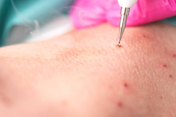 istock Laser therapy in nipples 1191053118