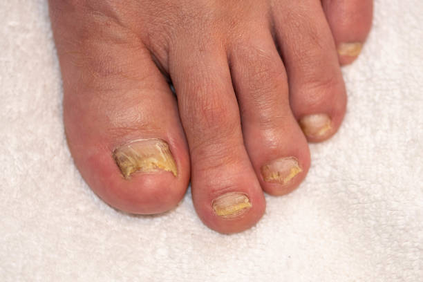 Toenail fungus. Toenails infected by fungus can be seen being replaced by the healthy nail growth following the successful treatment. trichophyton fungus stock pictures, royalty-free photos & images