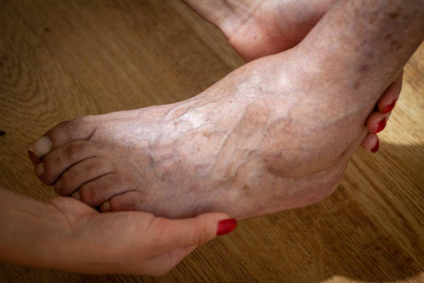 closeup feet of old an suffering from leprosy closeup feet of old man suffering from leprosy with a cane on the ground leprosy stock pictures, royalty-free photos & images