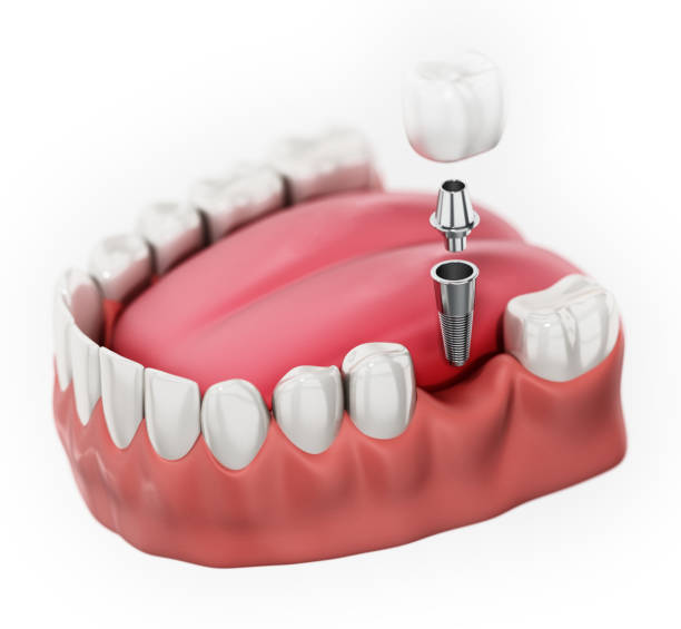 istock Tooth implant placed on lower jaw isolated on white 1191395784