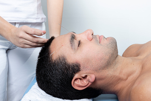 Therapist adjusting acupuncture needles on man head in aculpulture treatment.