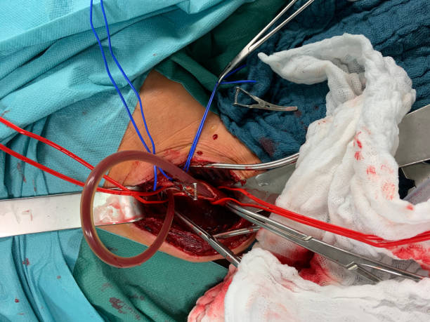 в сонной хирур�гии, атерии сонной подвергается и завернутые в красные и синие вожжи - surgery human artery human hand carotid artery стоковые фото и изображения