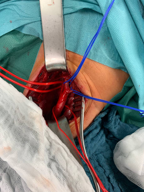 en la cirugía carótida, la ateria carotis se expone y envuelve en las retas rojas y azules - surgery human artery human hand carotid artery fotografías e imágenes de stock