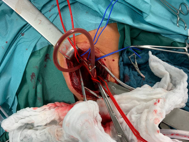 en la cirugía carótida, la ateria carotis se expone y envuelve en las retas rojas y azules - surgery human artery human hand carotid artery fotografías e imágenes de stock