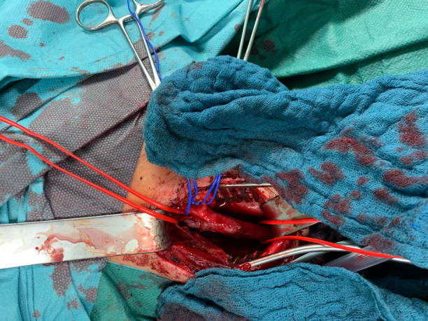 в сонной хирургии, атерии сонной подвергается и завернутые в красные и синие вожжи - surgery human artery human hand carotid artery стоковые фото и изображения