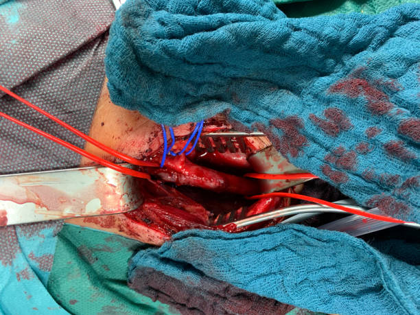 en la cirugía carótida, la ateria carotis se expone y envuelve en las retas rojas y azules - surgery human artery human hand carotid artery fotografías e imágenes de stock