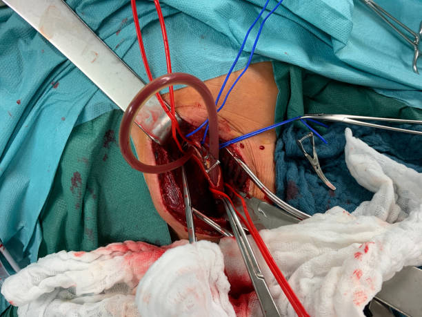 в сонной хирургии, атерии сонной подвергается и завернутые в красные и синие вожжи - surgery human artery human hand carotid artery стоковые фото и изображения