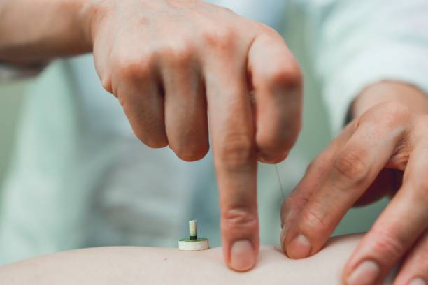 agopuntura e moxibustion in asia - acupuncture spa treatment asian culture medicine foto e immagini stock