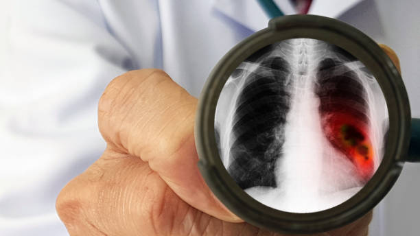 Oncologist doctor‘s holding stethoscope which show film X-ray(CXR) of lung mass. Lung cancer or carcinoma is malignant tumor which can spread (metastasis). Medical examination technology concept Doctor's physical examination for screening lung cancer metastasis photos stock pictures, royalty-free photos & images