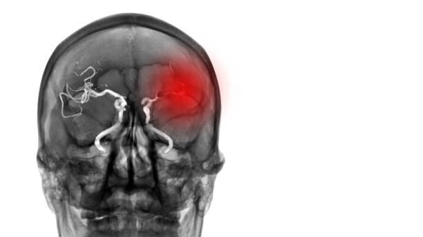 ct scan (computerisierte tomographie) zeigen abwesenheit von blutfluss zum linken gehirn. der patient hat ischämischen schlaganfall oder zerebrovaskuläre erkrankung von atherosklerotischer stenose. neurologisches untersuchungskonzept - schlaganfall stock-fotos und bilder