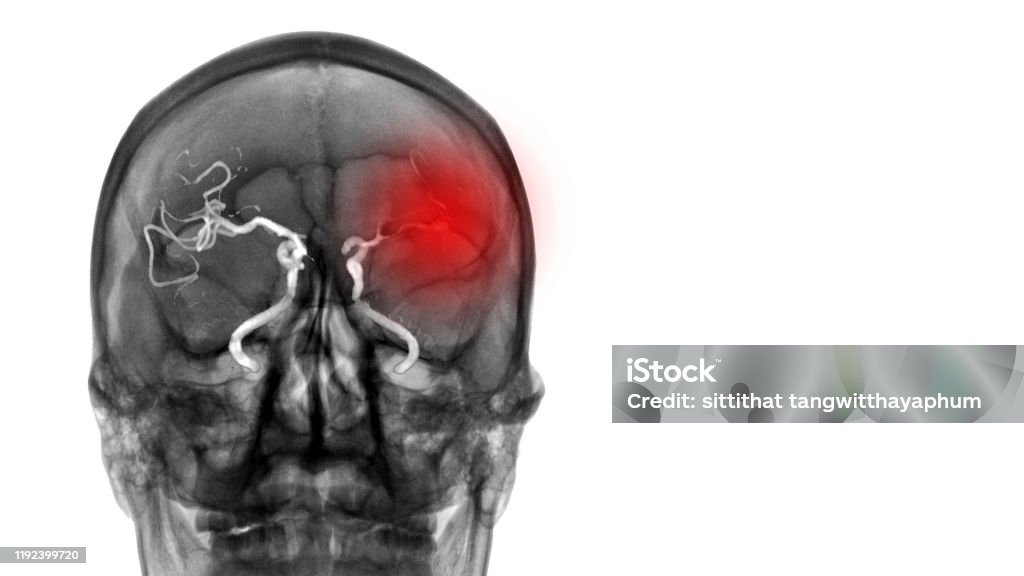 CT Scan(Computerized Tomography) show absence of blood flow to left brain. The patient has ischemic stroke or cerebrovascular disease from atherosclerotic stenosis. Neurology investigation concept Doctor examination for diagnosis disease Stroke - Illness Stock Photo