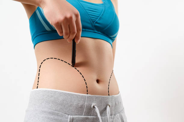女性は彼女の体の脂肪吸引ゾーンに点線を示す - 腹筋ローラー ストックフォトと画像