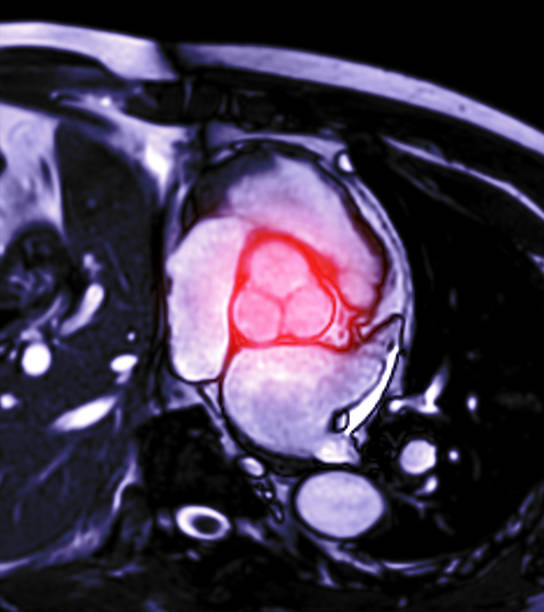 irm cardiaque ou irm cardiaque ( imagerie par résonance magnétique ) du cœur montrant la valve aortique pour le diagnostic de la maladie cardiaque. - valvule cardiaque photos et images de collection