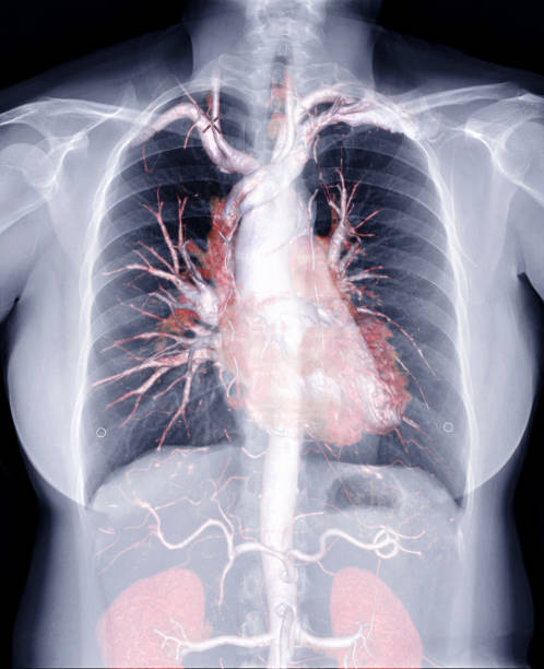 istock Merging Chest X-ray image with 3D rendering image of CTA whole aorta inside the chest. 1192620657