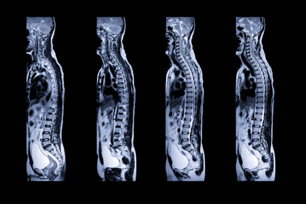 mrt der ganzen wirbelsäule - lähmung stock-fotos und bilder