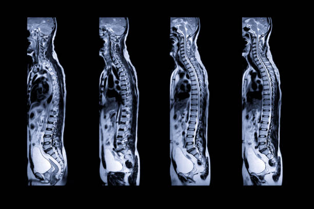 MRI of whole spine Collection of MRI of whole spine  T2W sagittal  plane for diagnostic Spinal Cord Compression. cervical vertebrae photos stock pictures, royalty-free photos & images